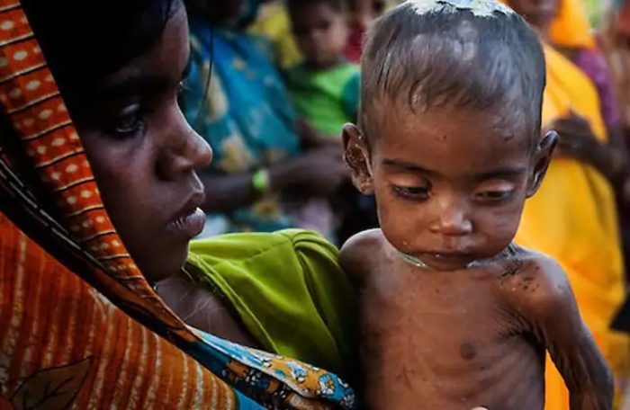 malnutrition cases in mp