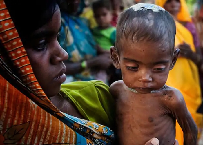malnutrition cases in mp