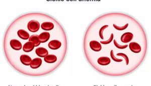 sickle cell anemia