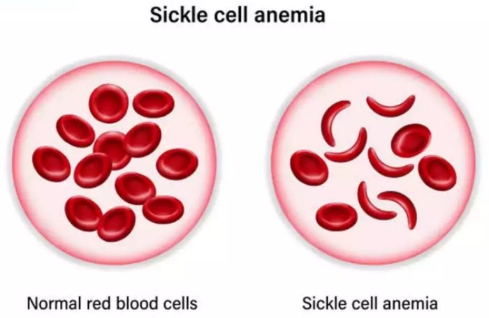 sickle cell anemia